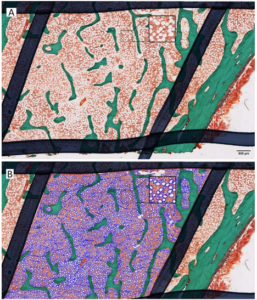 Bone Biopsy with autmoated adipocyte analysis from FRAME study